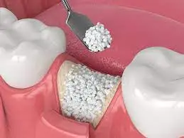 Illustration of bone graft material placed around a dental implant post to rebuild jawbone volume, with a zoomed detail showing granular graft material application