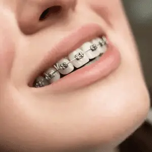 Braces TreatmenBraces Treatment Miamit Miami