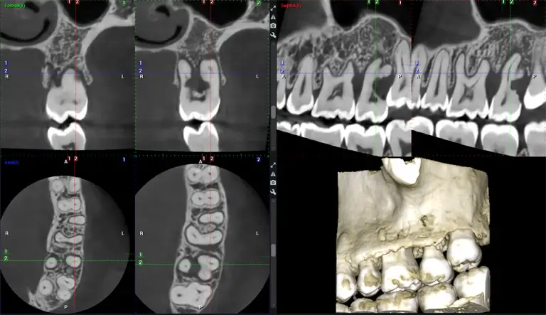Planmeca CBCT Low Radiation G7 Endodontic Study Miami