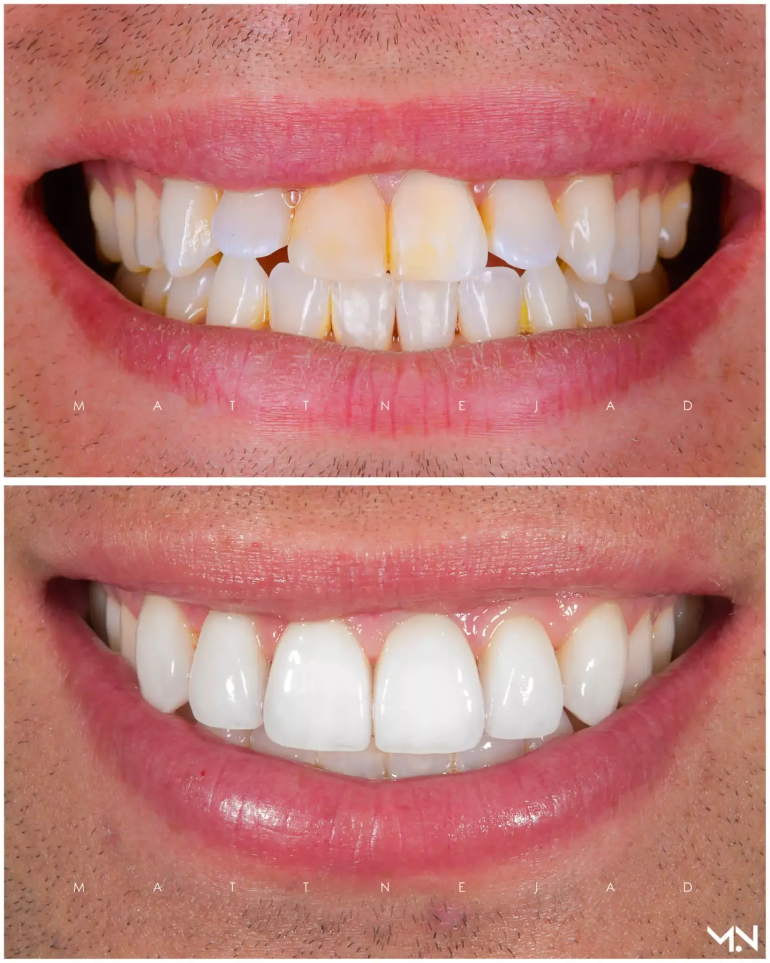 Cosmetic smile makeover with porcelain veneers at Dr. G Dental Studio in Miami