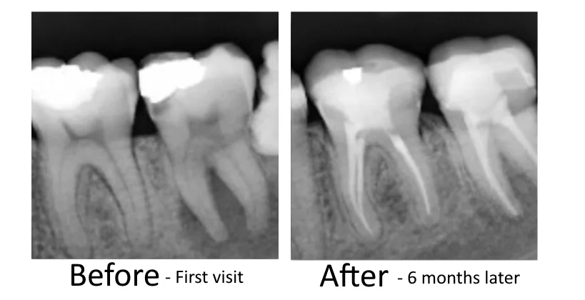 Before and after root canal therapy at Dr. G Dental Studio in Miami