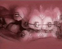 Orthodontic bonding setup